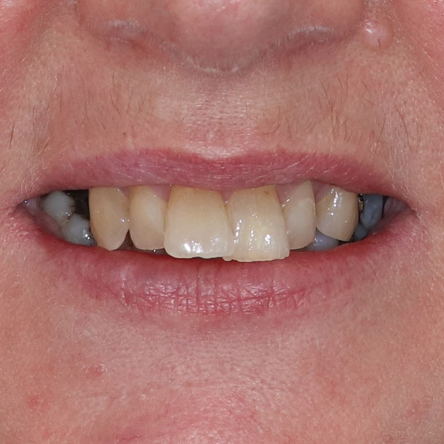 Dental Implant Vs Bridge: Pros & Cons, Cost, And Which Treatment Is Best?