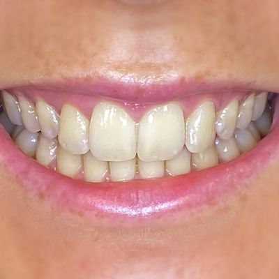 Prosthodontic Treatments | Dental Prostheses // 3Dental In Dublin ...