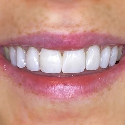 Prosthodontic Treatments | Dental Prostheses // 3Dental In Dublin ...