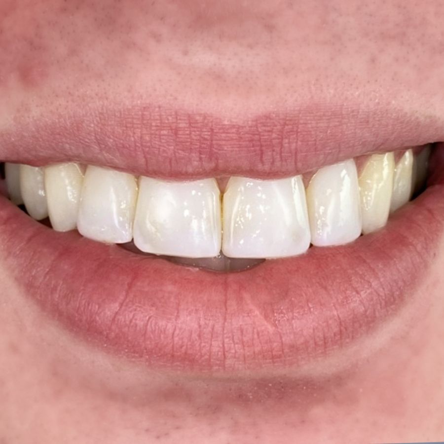 What Is Composite Bonding? | Before And After // 3Dental