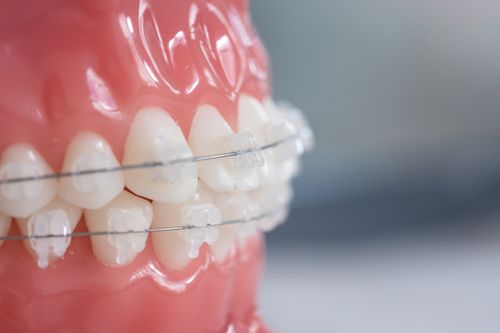 Orthodontic Device Instructions // 3Dental