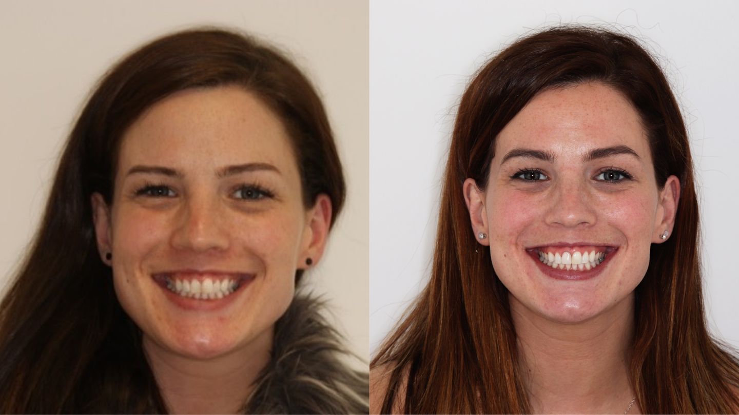 Invisalign Before and After Pictures | 3 & 6 Month Results and Reviews ...