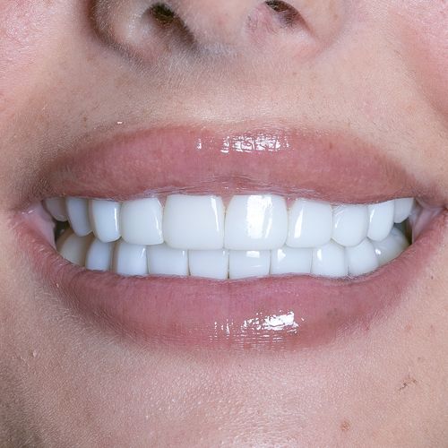 Smile Gallery | Before & Afters | Smile Makeover // 3Dental